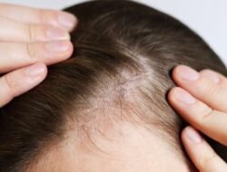 Hair Transplant Cost in Bhubaneswar