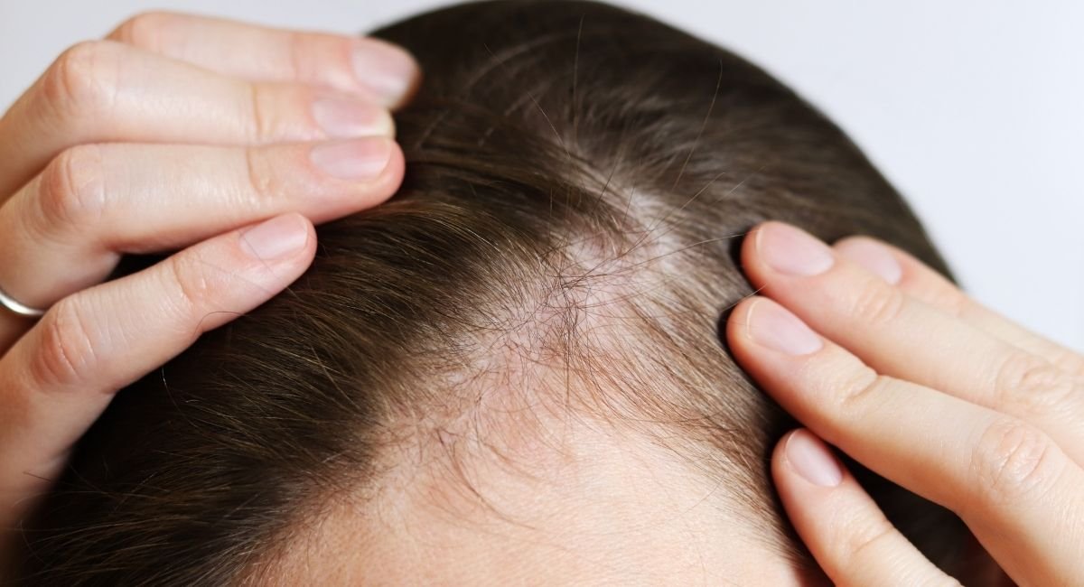 Hair Transplant Cost in Bhubaneswar
