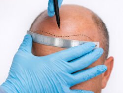 Top 10 Benefits of Hair Transplant You Should Know