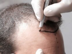 Who Is the Right Candidate for a Hair Transplant?