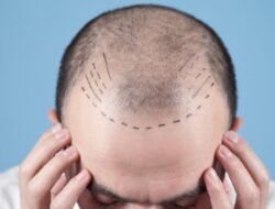Hair Transplant in 2026: Latest Techniques, Cost & Success Rate