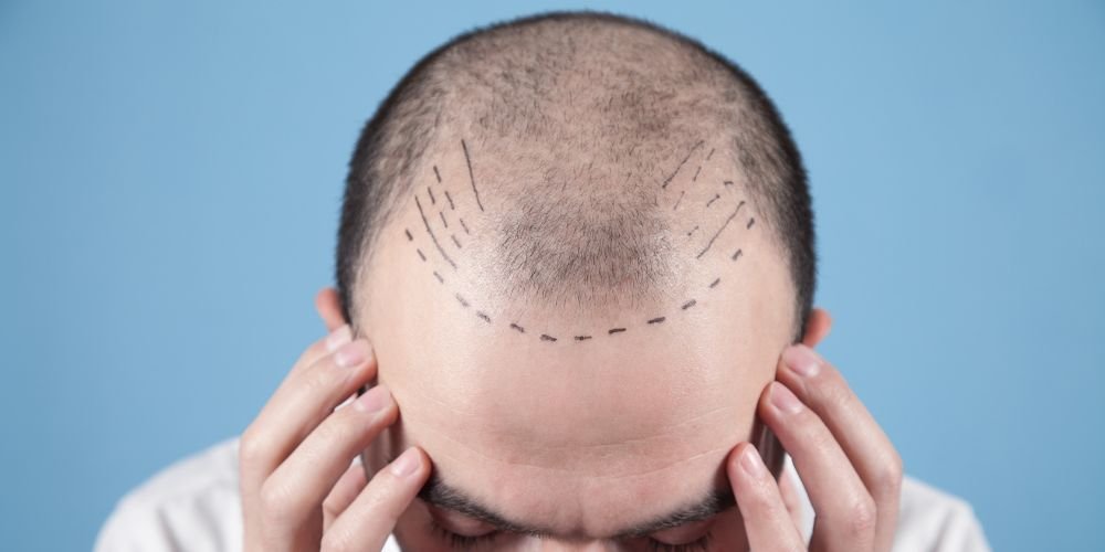 Hair Transplant in 2026: Latest Techniques, Cost & Success Rate