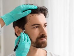 Top Tips to Choose a Trusted Hair Transplant Surgeon in Delhi