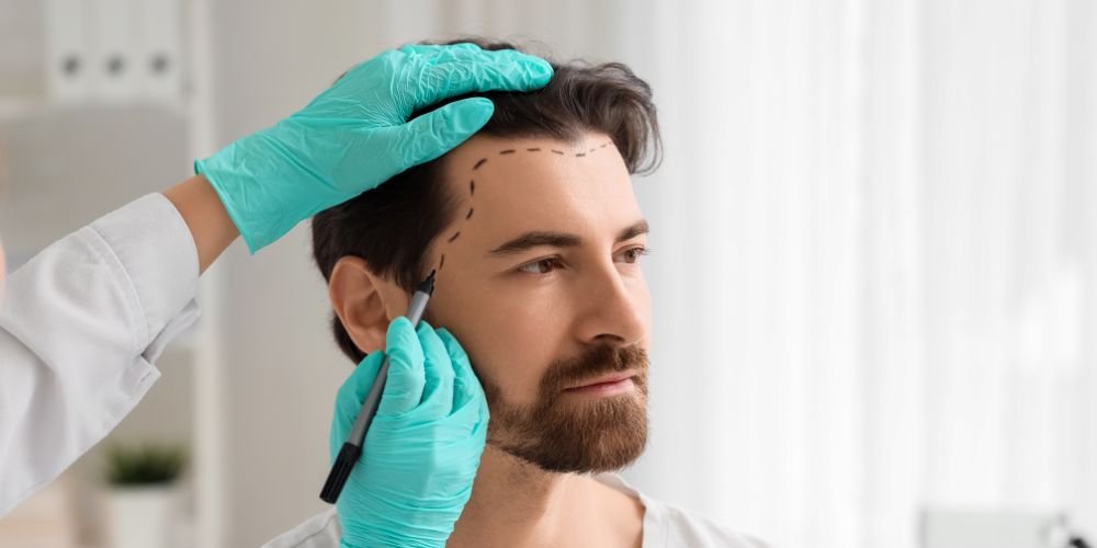 Top Tips to Choose a Trusted Hair Transplant Surgeon in Delhi