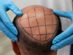 A Complete Guide to Choosing the Best Hair Transplant Surgeon