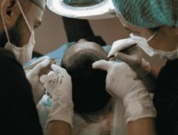 Is Hair Transplant in Delhi Safe and Affordable?