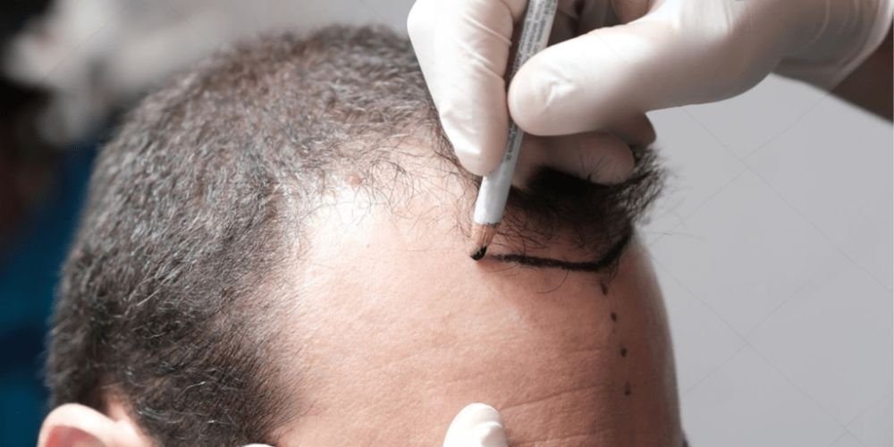 Who Is the Right Candidate for a Hair Transplant?