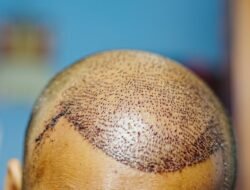 When Can You Wear a Hat or Helmet After a Hair Transplant?