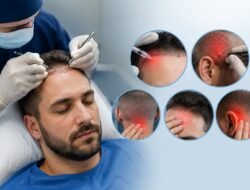 How Much Pain Is Experienced During Hair Transplant Surgery?