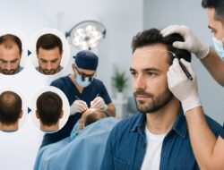 Does Choosing the Right Surgeon Improve Hair Transplant Results?
