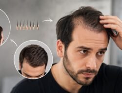 Is Hair Transplantation the Best Solution for Thinning Hair?
